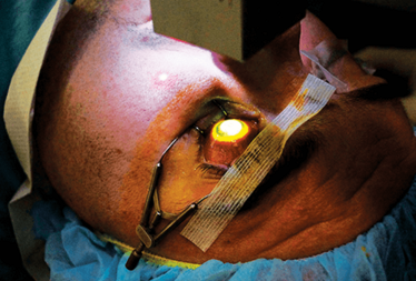 Figure 2. Patient undergoing the corneal cross-linking procedure Figure 2. Patient undergoing the corneal cross-linking procedure