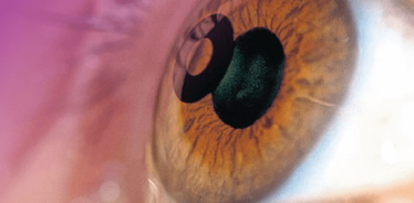 Mainteaser of Building a Presbyopia Practice Mainteaser of Building a Presbyopia Practice