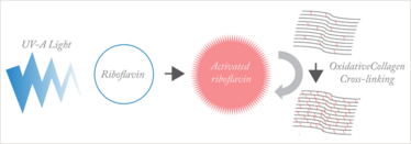Figure 1. Main principles of photo-oxidative corneal cross-linking. Figure 1. Main principles of photo-oxidative corneal cross-linking.