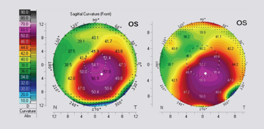 Figure 4. Pre-operative Pentacam image (A) and 1 year post- corneal cross-linking image (B). Figure 4. Pre-operative Pentacam image (A) and 1 year post- corneal cross-linking image (B).
